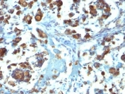 IHC: Formalin-fixed, paraffin-embedded human gastric carcinoma stained with Mucin-3 antibody (M3.1).