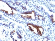 IHC: Formalin-fixed, paraffin-embedded human gastric carcinoma stained with Mucin-3 antibody (M3.1).