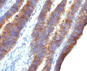 IHC: Formalin-fixed, paraffin-embedded human colon carcinoma stained with Mucin-3 antibody (M3.1).~