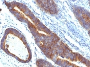 IHC: Formalin-fixed, paraffin-embedded human colon carcinoma stained with MUC3 antibody (MUC3/1154).