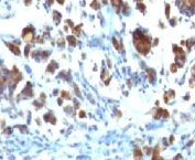 IHC: Formalin-fixed, paraffin-embedded human gastric carcinoma stained with MUC3 antibody (MUC3/1154).