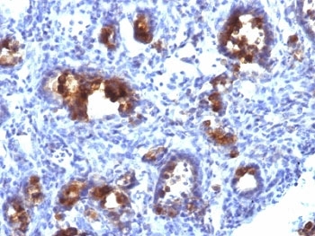 IHC: Formalin-fixed, paraffin-embedded human gastric carcinoma stained with MUC3 antibody (MUC3/1154).~