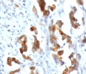 IHC testing of FFPE human gastric carcinoma with MUC5AC antibody (clone CLH2). Required HIER: steam section in pH 9 10mM Tris with 1mM EDTA for 20 min and allow to cool prior to testing.