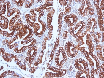 IHC testing of FFPE human gastric carcinoma with MUC5AC antibody (clone CLH2). Required HIER: steam section in pH 9 10mM Tris with 1mM EDTA for 20 min and allow to cool prior to testing.~