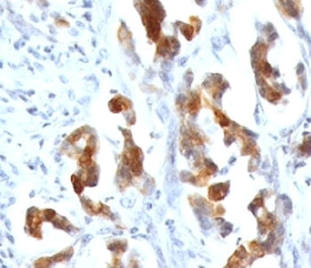 IHC testing of FFPE human gastric carcinoma with