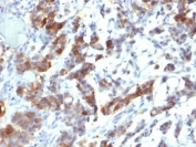 IHC: Formalin-fixed, paraffin-embedded human gastric carcinoma stained with MUC5AC antibody (MUC5AC/917 + 45M1).