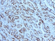 IHC testing of FFPE human gastric carcinoma with MUC6 antibody (clone CLH5). HIER: steam section in pH6 citrate buffer for 20 min and allow to cool prior to testing. Image courtesy of Dr. Leonor David, IPATIMUP and Medical Faculty, University of Porto, Portugal.