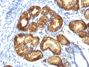 IHC: Formalin-fixed, paraffin-embedded human gastric carcinoma stained with MUC6 antibody (clone CLH5). HIER: steam section in pH6 citrate buffer for 20 min and allow to cool prior to testing.~