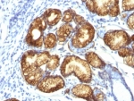 IHC: Formalin-fixed, paraffin-embedded human gastric carcinoma stained with MUC6 antibody (clone CLH5). HIER: steam section in pH6 citrate buffer for 20 min and allow to cool prior to testing.