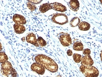 IHC: Formalin-fixed, paraffin-embedded human gastric carcinoma stained with Mucin-6 antibody (MUC6/916).~
