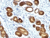 IHC: Formalin-fixed, paraffin-embedded human gastric carcinoma stained with Mucin-6 antibody (MUC6/916).