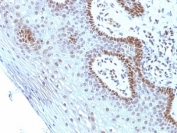 IHC analysis of formalin-fixed, paraffin-embedded human cervical carcinoma stained with Myc antibody (clone SPM237).