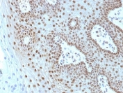 IHC: Formalin-fixed, paraffin-embedded human cervical carcinoma stained with c-Myc antibody (MYC275 + MYC909).