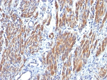 IHC: Formalin-fixed, paraffin-embedded human Leiomyosarcoma stained with SM-MHC antibody (clone SMMS-1).~