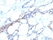 IHC: Formalin-fixed, paraffin-embedded human angiosarcoma stained with SM-MHC antibody (SPM201).