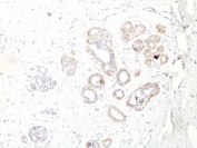 IHC: Formalin-fixed, paraffin-embedded human breast carcinoma stained with SM-MHC antibody (ID8).