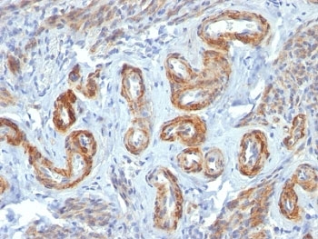 IHC: Formalin-fixed, paraffin-embedded human Leiomyosarcoma stained with SM-MHC antibody (ID8).~