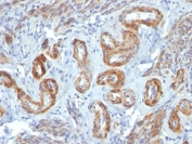 IHC: Formalin-fixed, paraffin-embedded human Leiomyosarcoma stained with SM-MHC antibody (ID8).