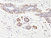 IHC: Formalin-fixed, paraffin-embedded human breast carcinoma stained with SMMHC antibody (MYH11/923).