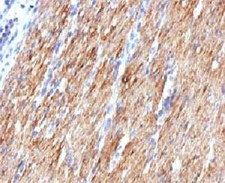 IHC: Formalin-fixed, paraffin-embedded human colon carcinoma stained with SMMHC antibody (MYH11/923).~