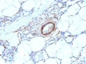 IHC: Formalin-fixed, paraffin-embedded human angiosarcoma stained with SMMHC antibody (MYH11/923).