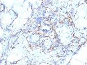IHC: Formalin-fixed, paraffin-embedded human angiosarcoma stained with SMMHC antibody (MYH11/923 + SMMS-1).