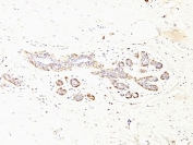IHC: Formalin-fixed, paraffin-embedded human breast carcinoma stained with SMMHC antibody (MYH11/923 + SMMS-1).