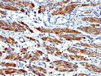 IHC: Formalin-fixed, paraffin-embedded human Leiomyosarcoma stained with SMMHC antibody (MYH11/923 + SMMS-1).~