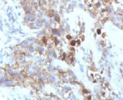 IHC: Formalin-fixed, paraffin-embedded human lung carcinoma stained with CD56 antibody.