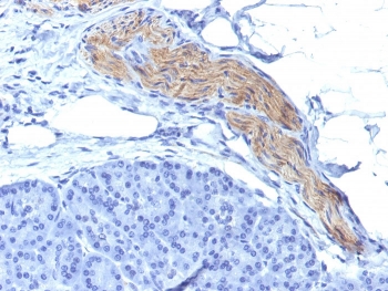 IHC: Formalin-fixed, paraffin-embedded human brain tumor stained with CD56 antibody.~