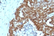 IHC: Formalin-fixed, paraffin-embedded human ovarian carcinoma stained with Nucleolin antibody.