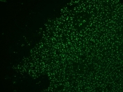 Immunofluorescent staining of human colon carcinoma with Nucleolin antibody (clone NCL/902, green).