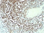 IHC: Formalin-fixed, paraffin-embedded human bladder carcinoma stained with Nucleolin antibody (364-5 + NCL/902).