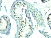 IHC: Formalin-fixed, paraffin-embedded human testicular carcinoma stained with Nucleolin antibody.