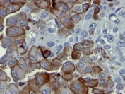 IHC analysis of formalin-fixed, paraffin-embedded human melanoma stained with p75NTR antibody (clone NGFR5).