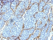 IHC analysis of formalin-fixed, paraffin-embedded human melanoma stained with NGF Receptor antibody (clone SPM299).