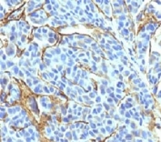 IHC: Formalin-fixed, paraffin-embedded human melanoma stained with NGFR antibody (NTR/912).