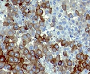 IHC: Formalin-fixed, paraffin-embedded human melanoma stained with NGFR antibody (NTR/912).~