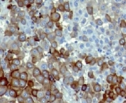 IHC: Formalin-fixed, paraffin-embedded human melanoma stained with NGFR antibody (NTR/912).