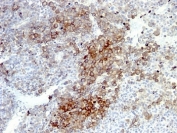 IHC: Formalin-fixed, paraffin-embedded human melanoma stained with NGF Receptor antibody (NGFR5 + NTR/912).