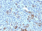 IHC: Formalin-fixed, paraffin-embedded human melanoma stained with NGF Receptor antibody (NGFR5 + NTR/912).