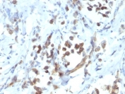 IHC: Formalin-fixed, paraffin-embedded human gastric carcinoma stained with PAX6 antibody (PAX6/1166).