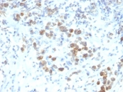 IHC: Formalin-fixed, paraffin-embedded human gastric carcinoma stained with PAX-6 antibody (SPM612).