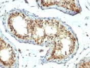 IHC: Formalin-fixed, paraffin-embedded human testicular carcinoma stained with PAX7 antibody (clone PAX7/1187). Required HIER: boil tissue sections in 10mM Tris buffer with 1mM EDTA, pH 9, for 10-20 min.