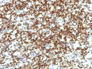 IHC testing of formalin-fixed, paraffin-embedded human Rhabdomyosarcoma with PAX7 antibody (clone PAX7/1187). Required HIER: boil tissue sections in 10mM Tris buffer with 1mM EDTA, pH 9, for 10-20 min.~