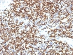 IHC testing of FFPE human Rhabdomyosarcoma with PAX-7 antibody (clone SPM613).