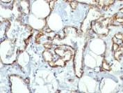 IHC: Formalin-fixed, paraffin-embedded human angiosarcoma stained with CD31 antibody (C31.10).