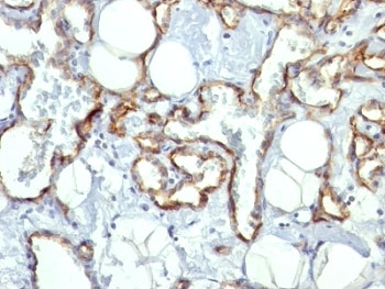 IHC: Formalin-fixed, paraffin-embedded human angiosarcoma stained with CD31 antibody (C31.10).~