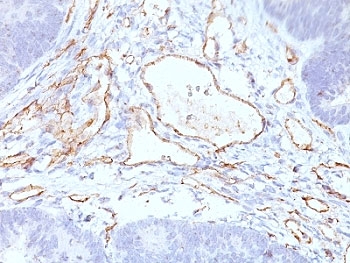 IHC: Formalin-fixed, paraffin-embedded colon carcinoma stained with CD31 antibody cocktail (C31.3+C31.7+C31.10).~