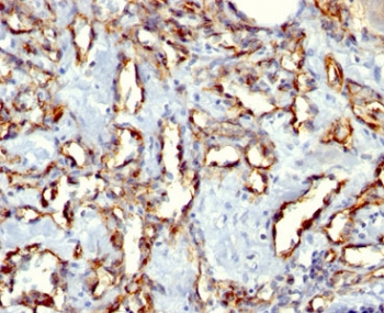 IHC: Formalin-fixed, paraffin-embedded human angiosarcoma stained with CD31 antibody cocktail (clones C31.3 + C31.7 + C31.1